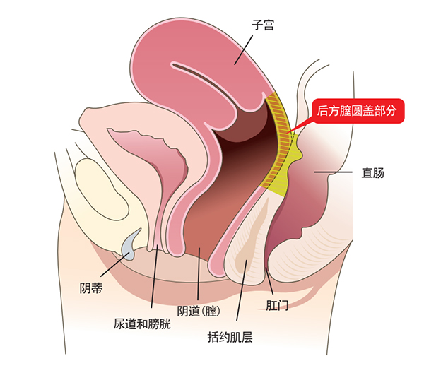 後方膣圓蓋術圖解