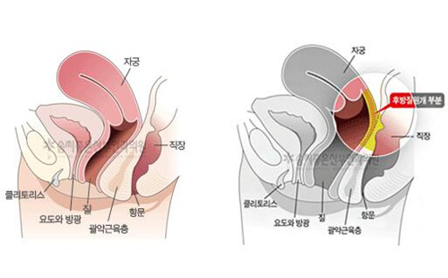 後方膣圓蓋術位置圖