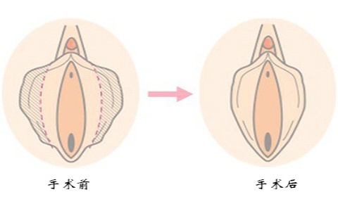 小阴唇术前术后对比图