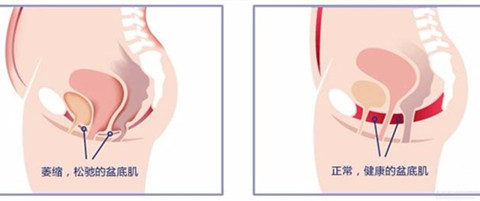 盆底肌松弛前後對比圖