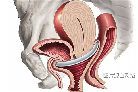 陰道壁膨出示意