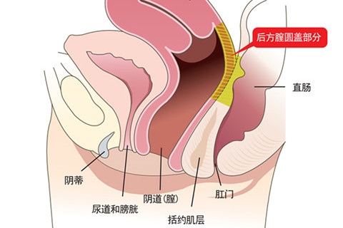 後方膣圓蓋術部位介紹