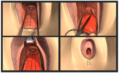 後方膣圓蓋術手術過程